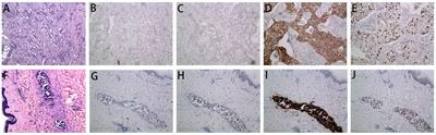 Bilateral inflammatory recurrence of HER-2 positive breast cancer: a unique case report and literature review